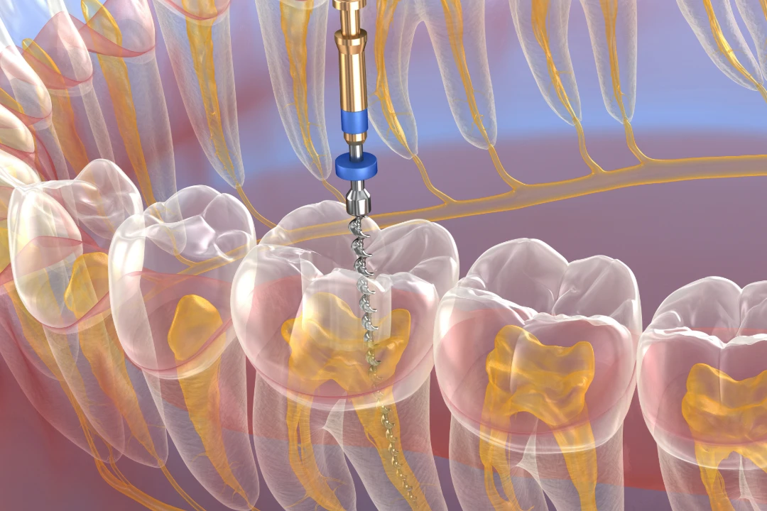 Endodoncia